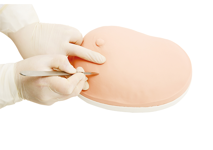 乳房良性肿物切除模型